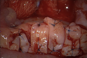 Crioconservazione tessuto Ovarico